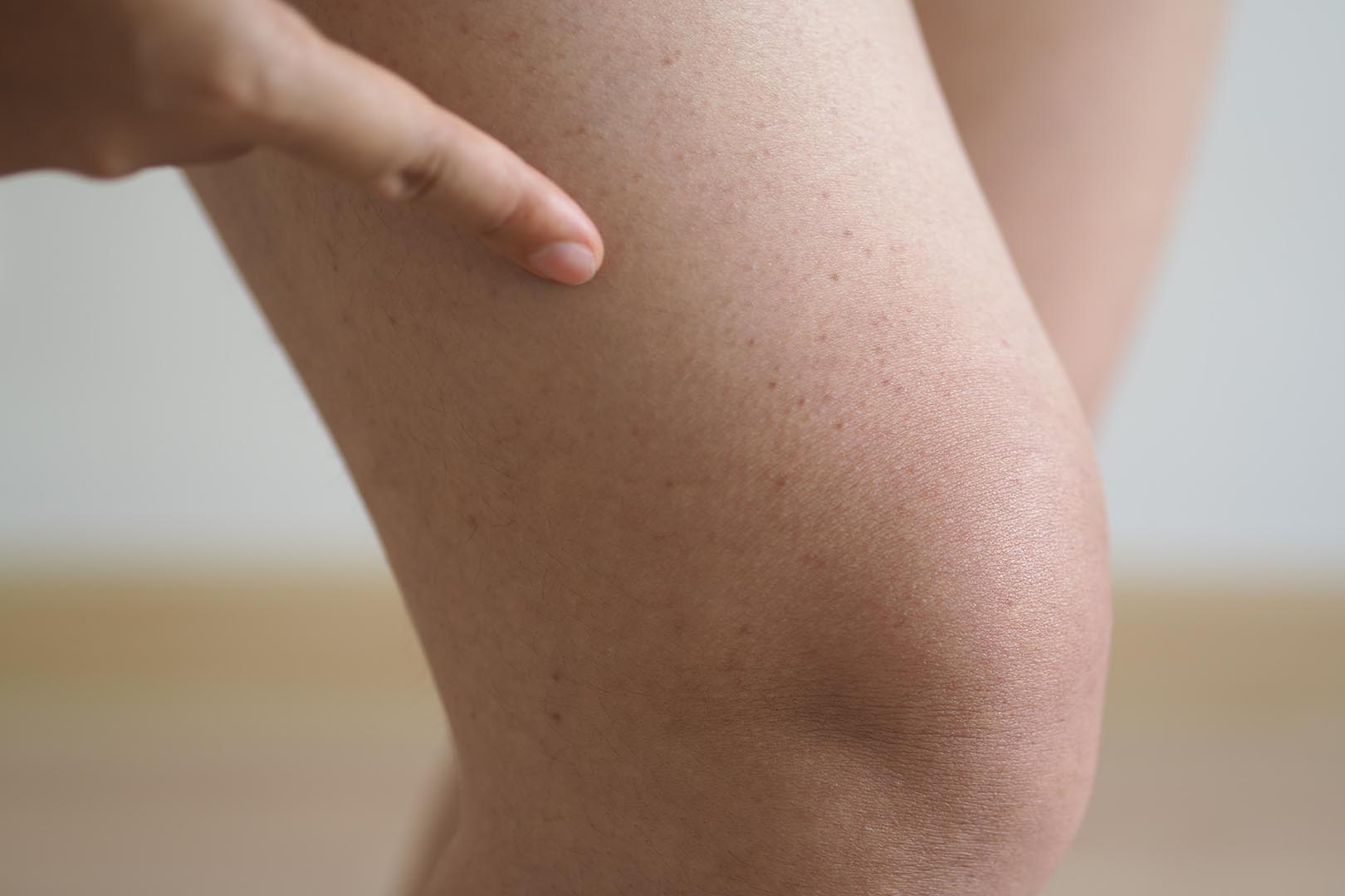 Idiopathic Thrombocytopenic Purpura (ITP)