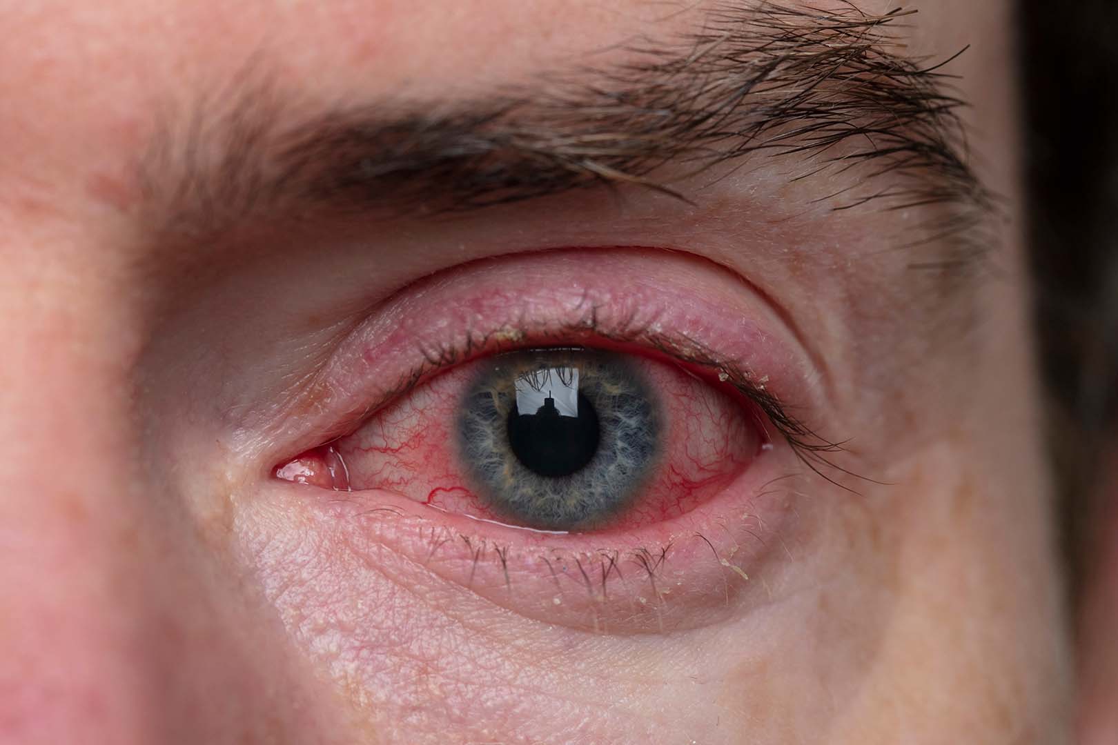 Konjungtivitis