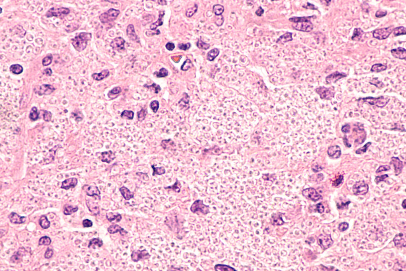 Histoplasmosis