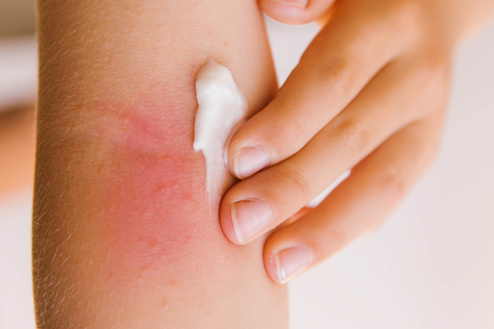 AIuminium Subacetate