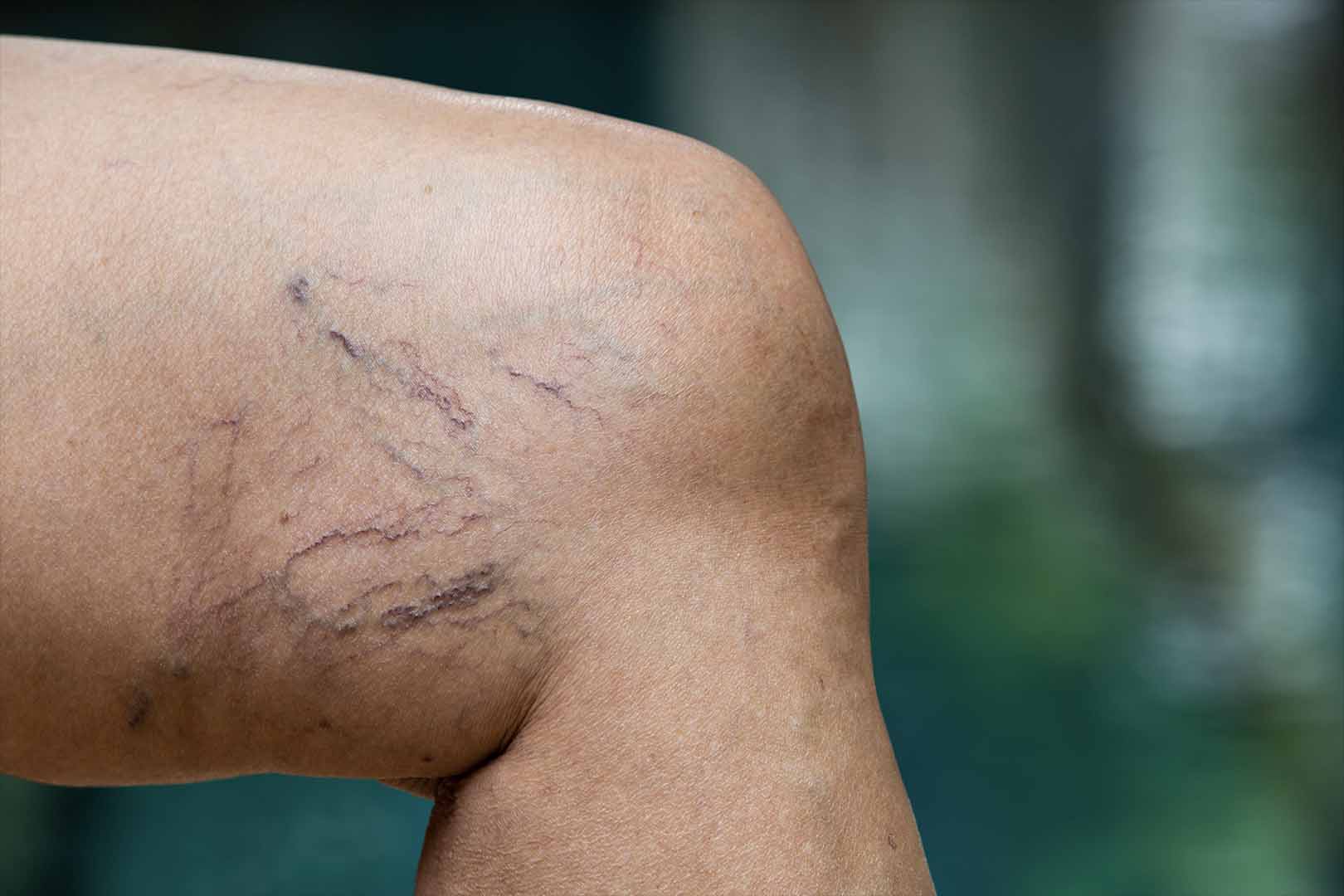 Cara Menghilangkan Varises: Mulai Cara Alami Hingga Medis