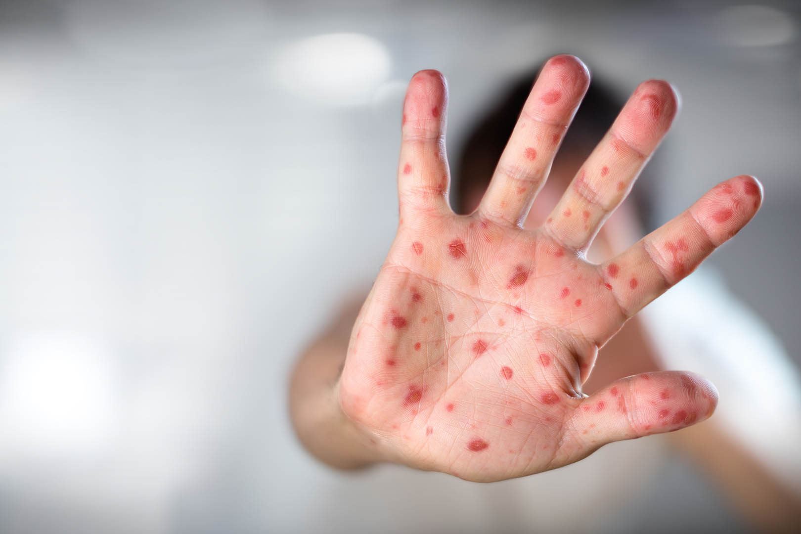 Mengenal Apa Itu Flu Singapura, Gejala, dan Pengobatannya