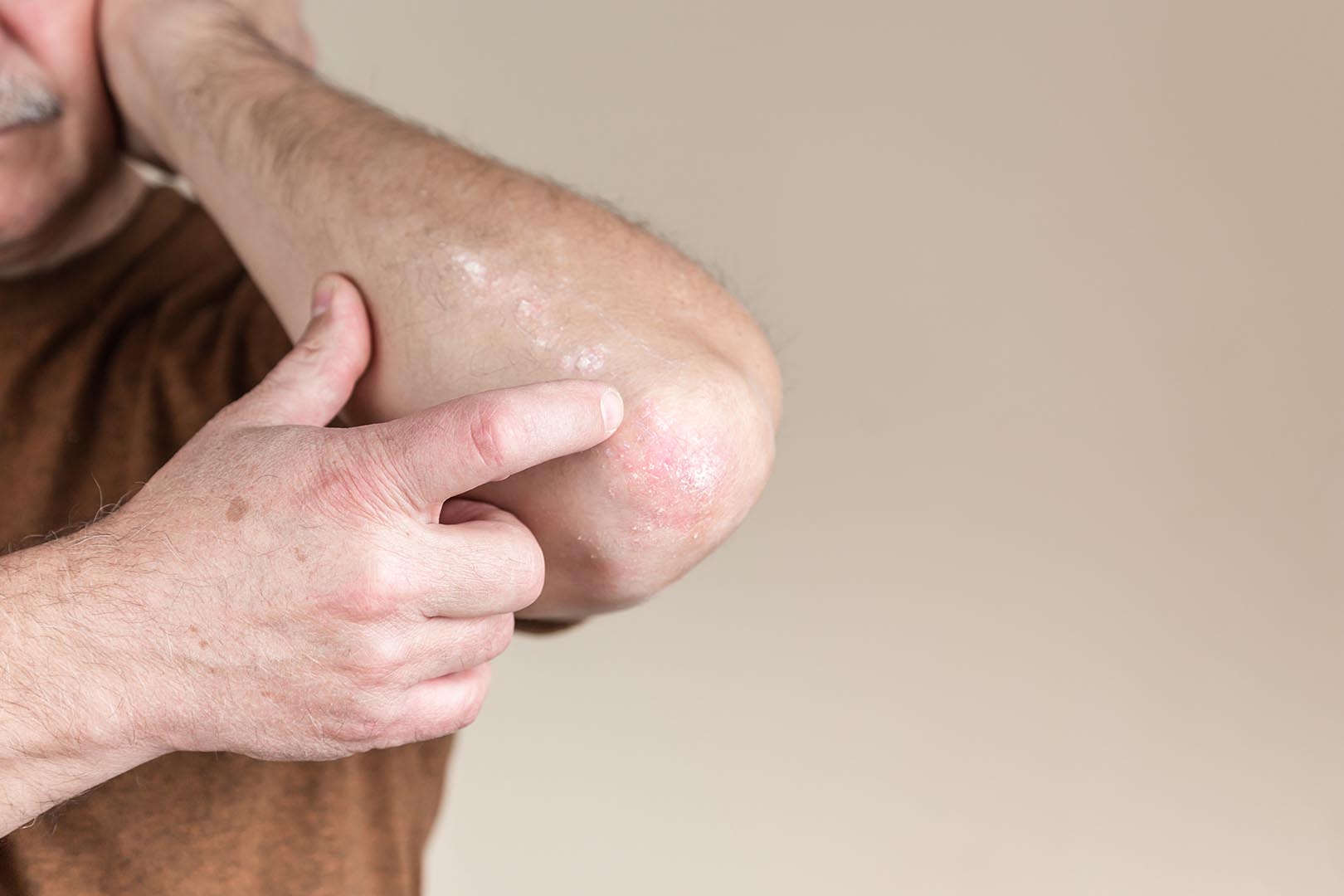 Iodochlorohydroxyquinoline