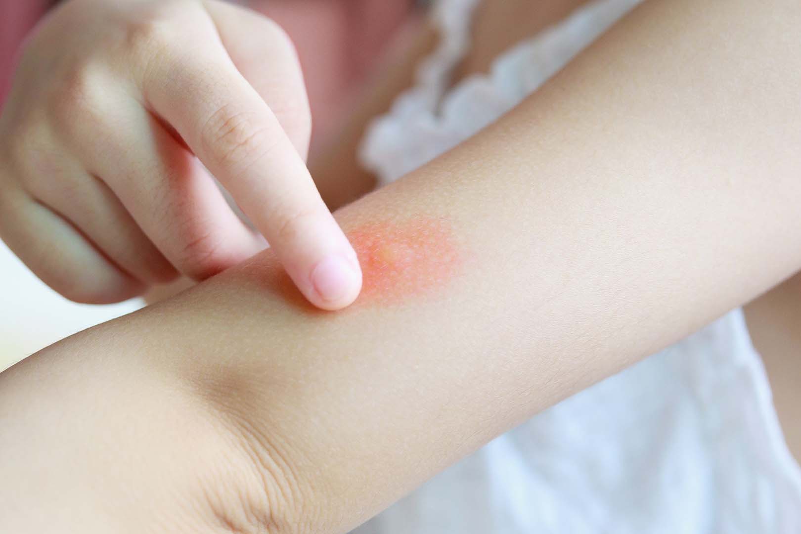 Clobetasol Propionate