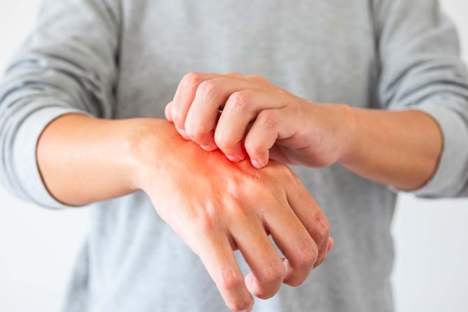 Gejala Alergi Dingin dan Pemilihan Obat yang Tepat