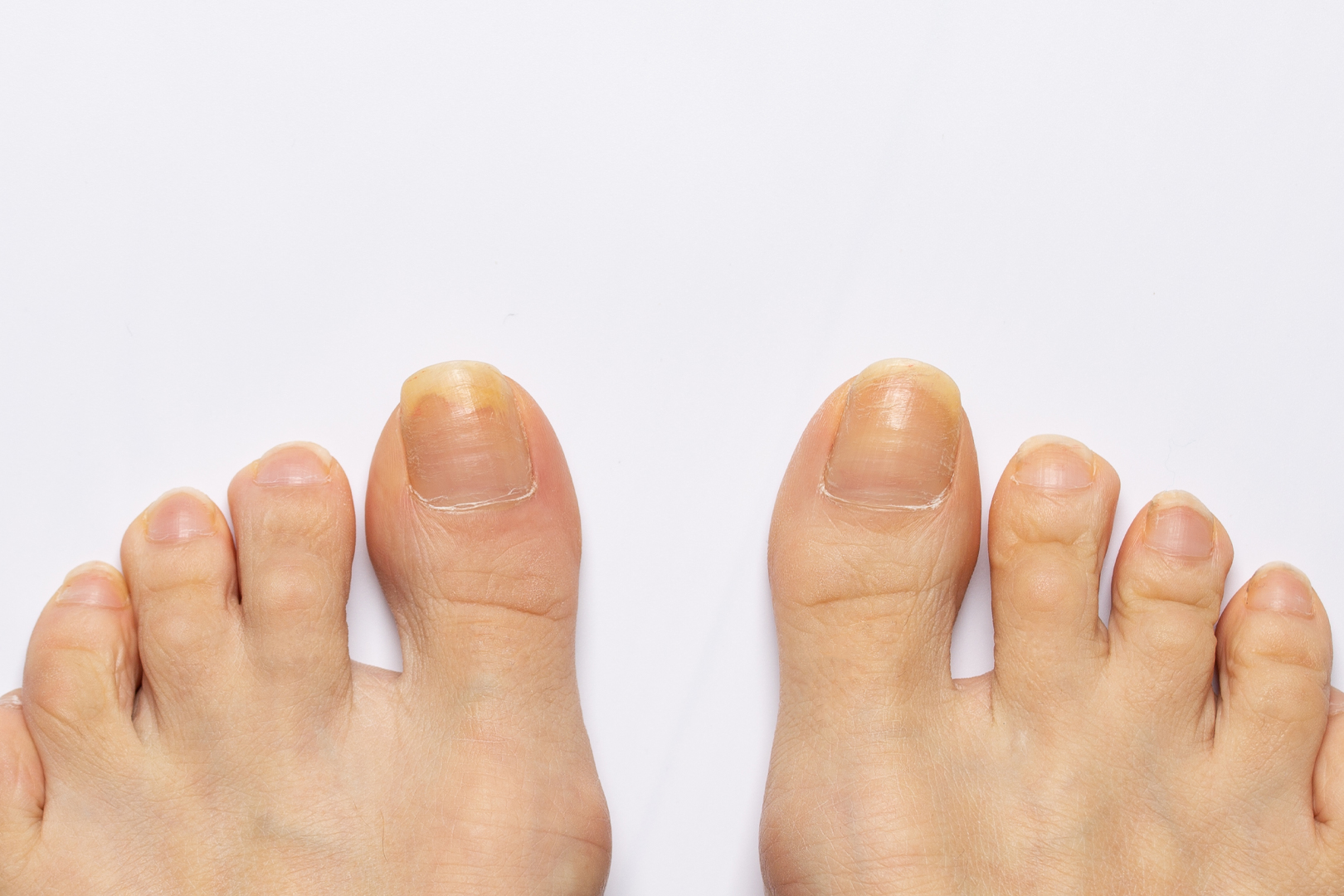 Apakah Diabetes Penyebab Kuku Kuning?