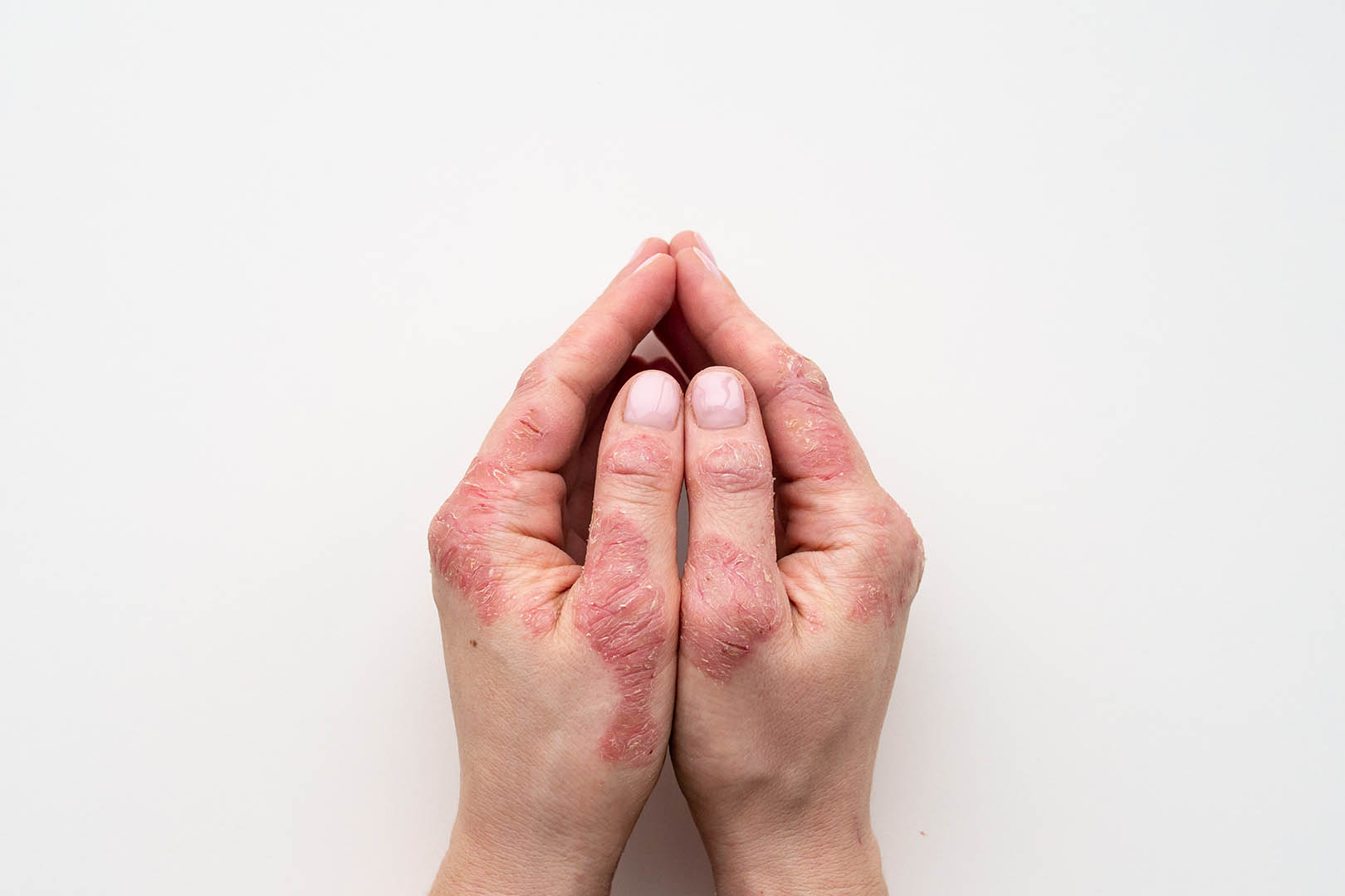 Obat Medixon: Manfaat, Dosis, Efek Samping