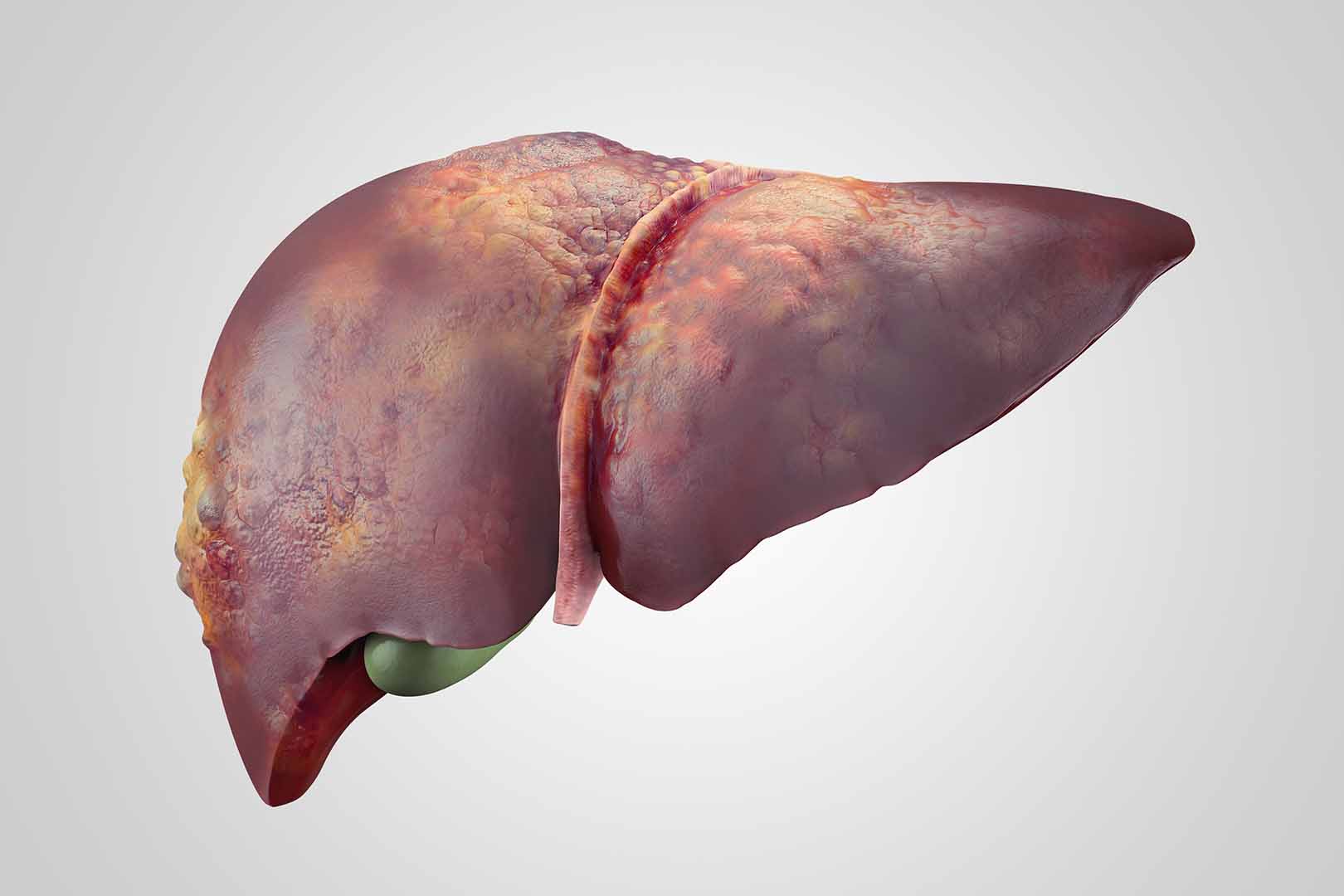 Sirosis Hati, Kerusakan Permanen Pada Hati Yang Perlu Anda Waspadai