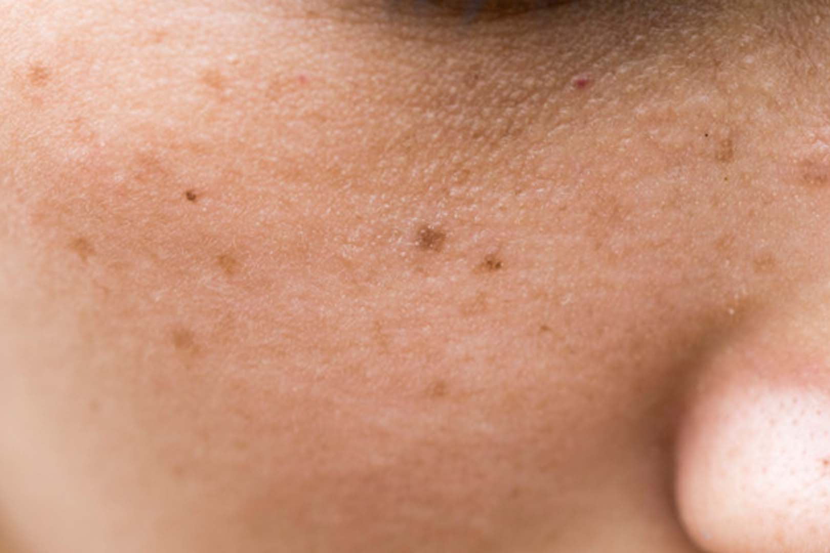 Vitaquin Cream: Efek Samping, Manfaat, dan Dosis