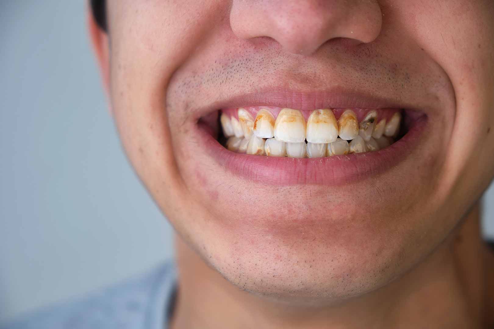 Penyakit Periodontal Yang Disebabkan Diabetes