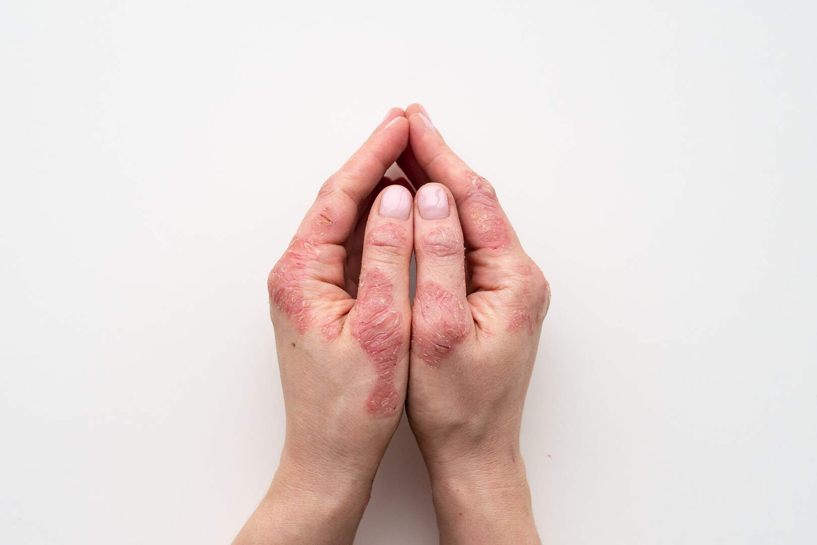 Cara Penularan Penyakit Kusta