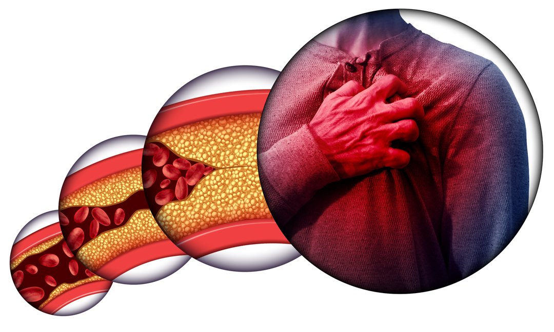 Mengenal Aterosklerosis, Penyumbatan Pembuluh Darah Penyebab Serangan Jantung