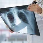 Kenali Penyakit Pneumonia dan Cara Mencegahnya