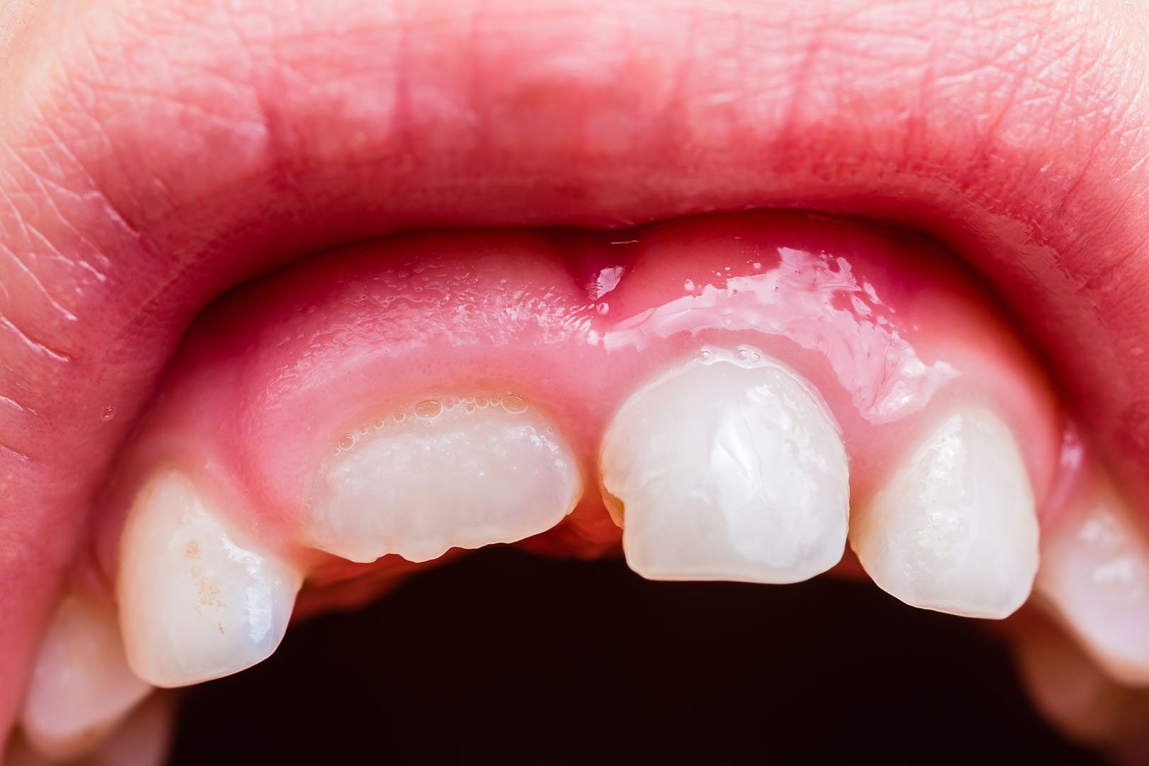 kenapa gigi sakit dan gusi bengkak 8