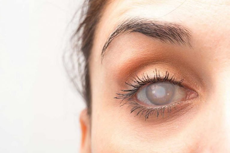 Katarak adalah suatu penyakit mata yang ditandai dengan mengeruhnya lensa mata, sehingga penglihatan seseorang menjadi kabur. Simak selengkapnya di sini.