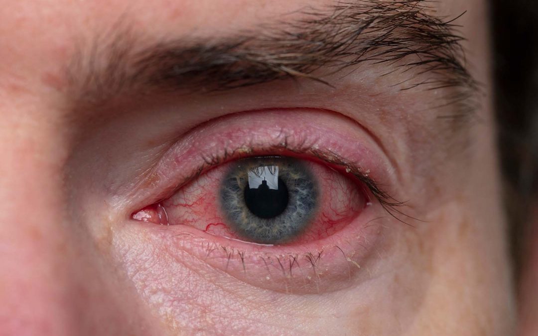 Konjungtivitis