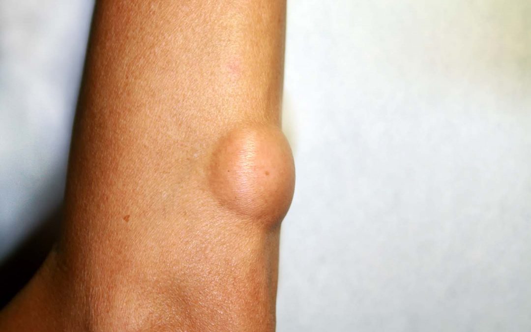 Liposarcoma