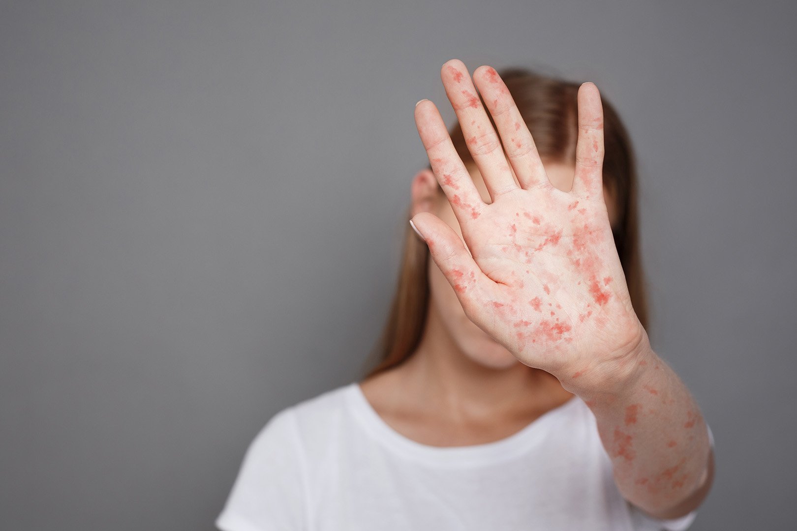 Menular adalah cara melalui kulit mencegah penyakit 8 Penyakit