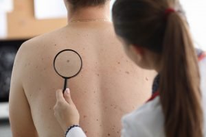melanoma-adalah
