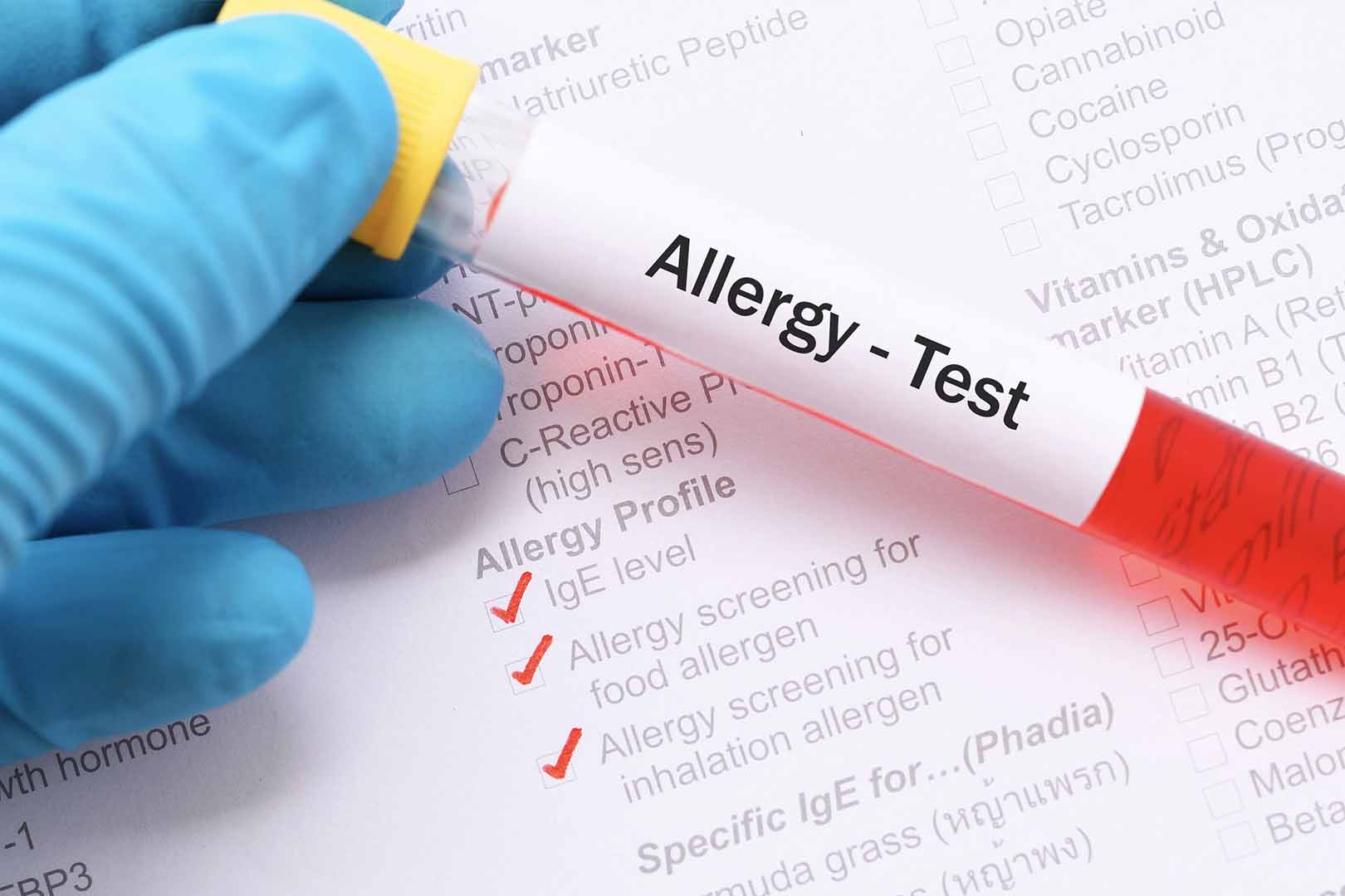 Tes Alergi, Apa Saja Jenis dan Bagaimana Prosedurnya?