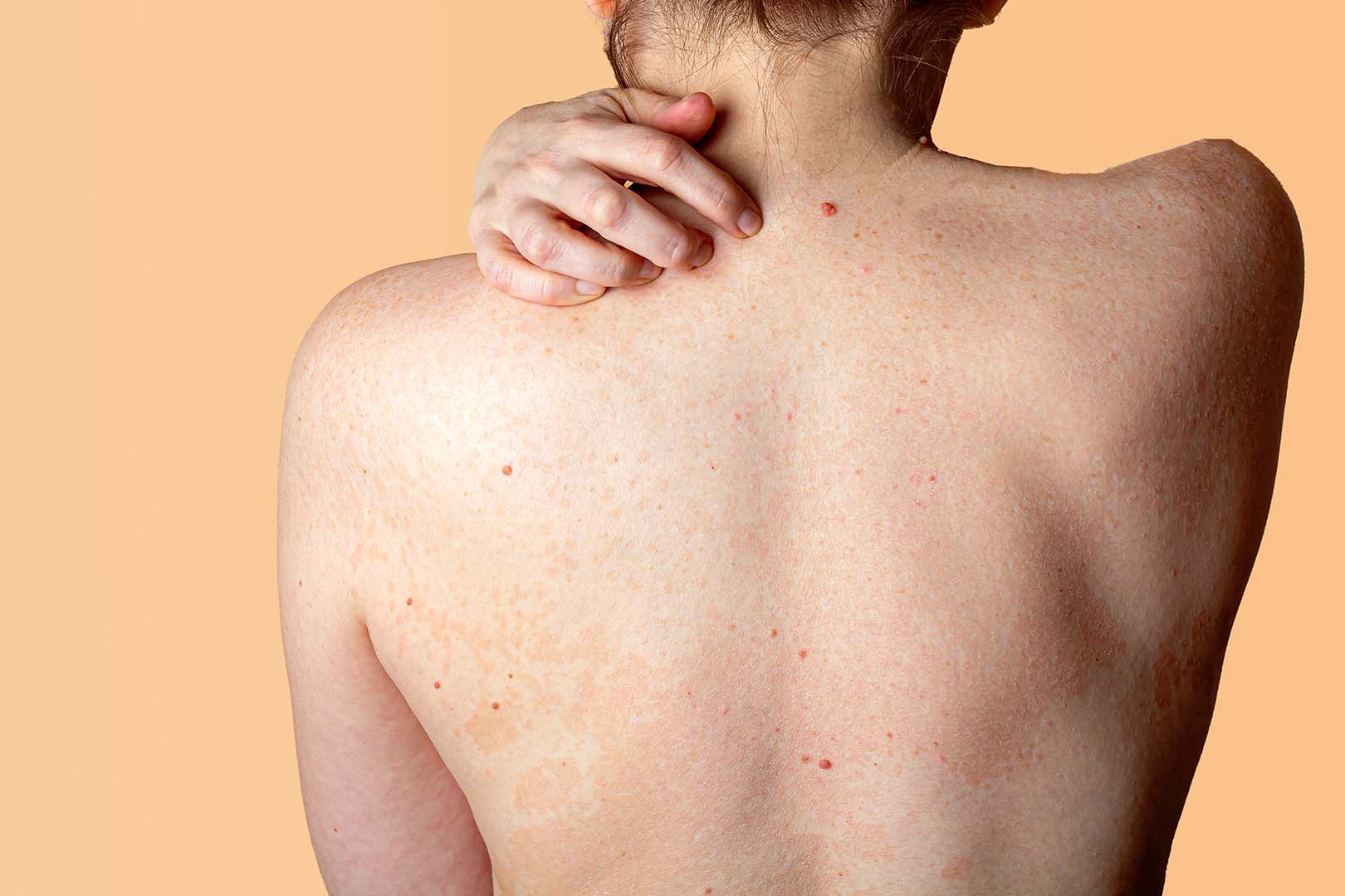 Cara mengobati bintik merah pada kulit disertai gatal